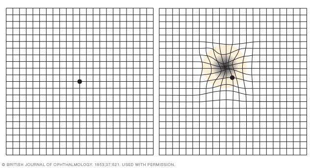 Amsler grid 