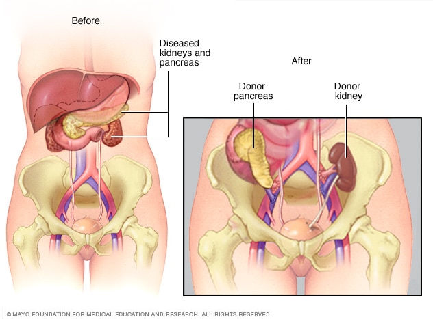 Transplanted pancreas and kidney 