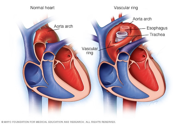 Vascular ring