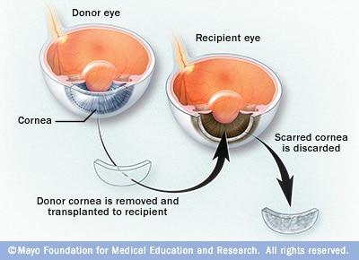 Cornea transplant 