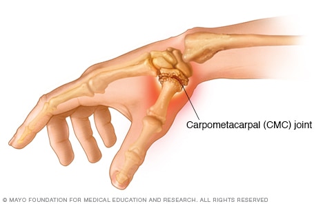 Thumb arthritis 