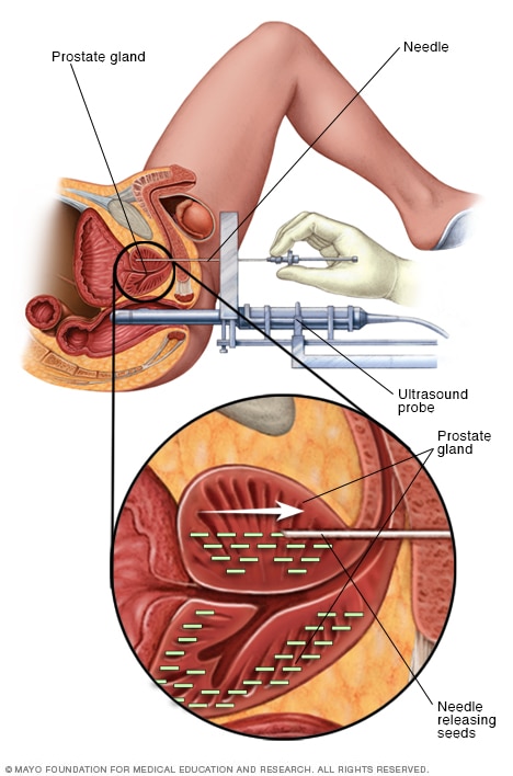 Permanent prostate brachytherapy