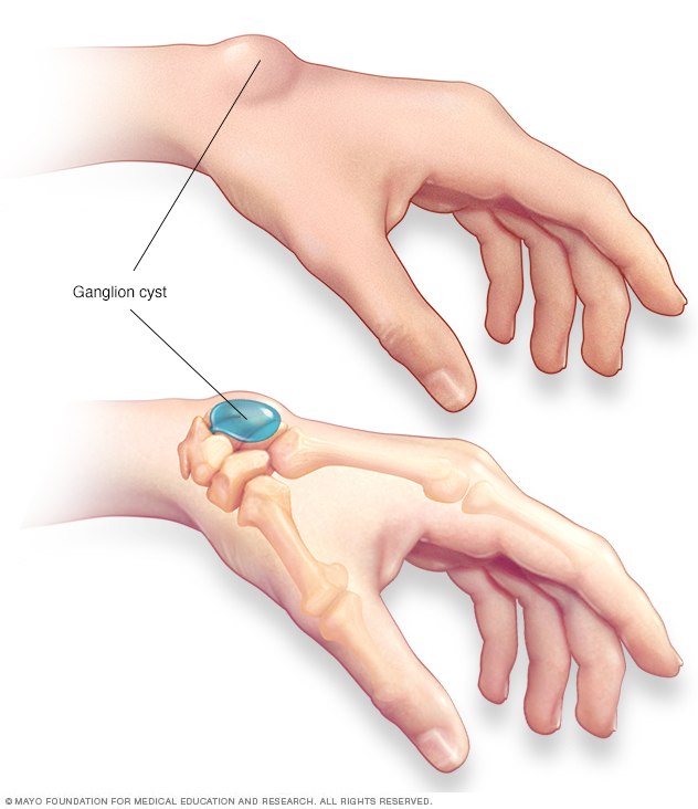 Ganglion cyst