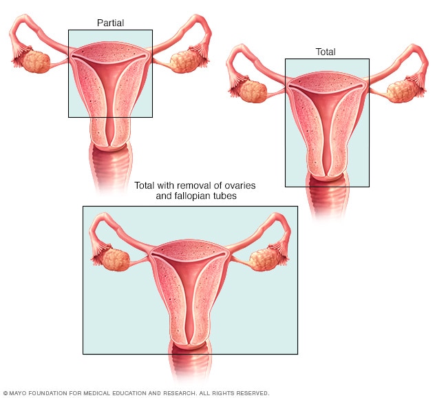 Types of hysterectomy surgery