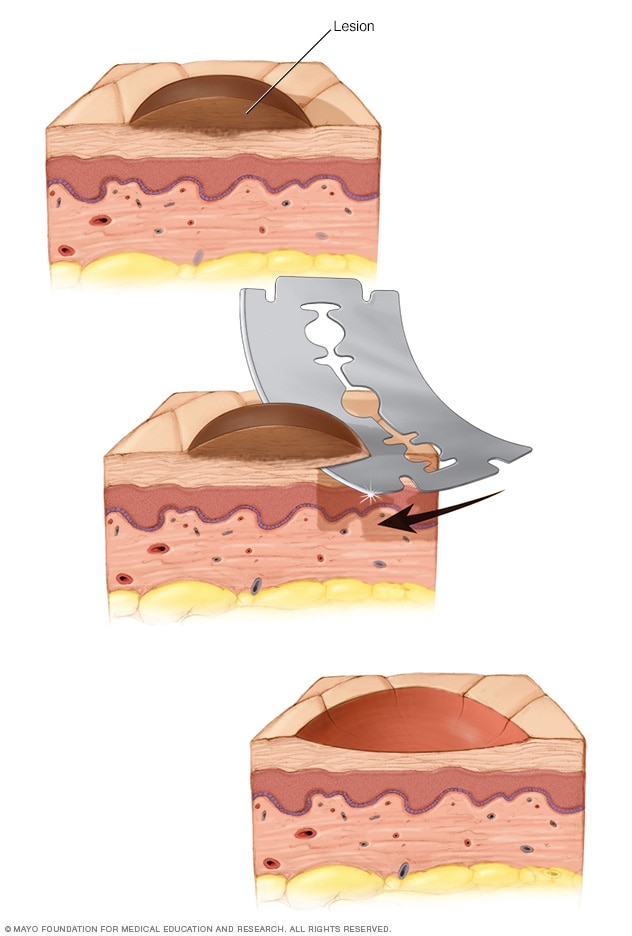 A razor is used to lift out irregular tissue. The result is a slightly indented area of skin that may heal with a scar.