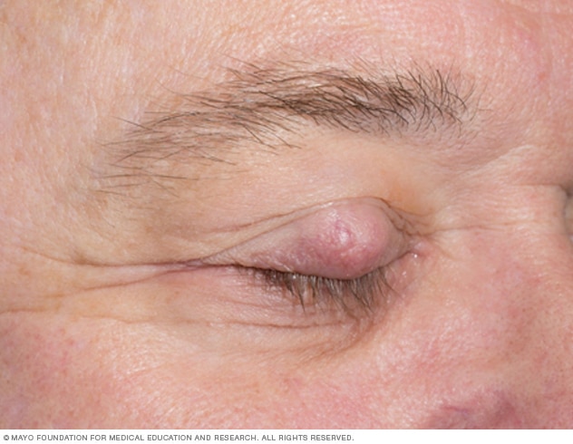 Sebaceous carcinoma on the eyelid