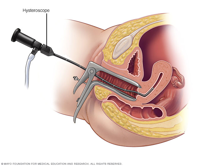 Hysteroscopy