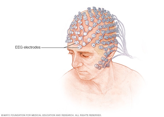 EEG electrodes