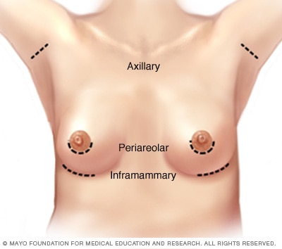 Breast augmentation incision sites